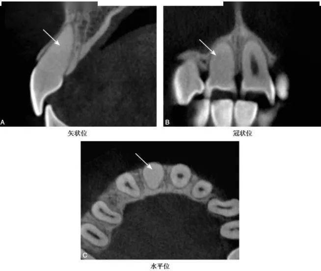 详述牙髓钙化的CBCT表现