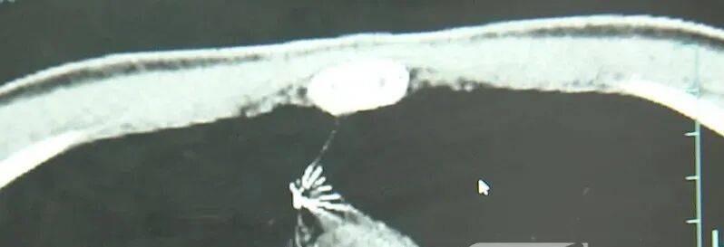 17岁小伙参军体检发现胸腔内有根5cm缝衣针<strong></p>
<p>比特儿海外版官网下载</strong>，父母回忆或是1岁时扎入，取出时已锈迹斑斑