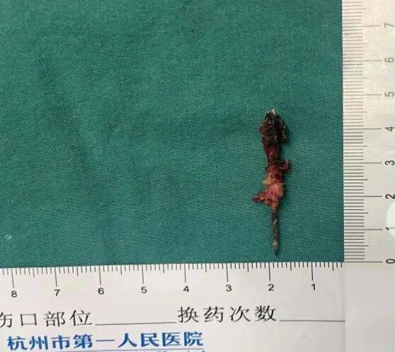 17岁小伙参军体检发现胸腔内有根5cm缝衣针<strong></p>
<p>比特儿海外版官网下载</strong>，父母回忆或是1岁时扎入，取出时已锈迹斑斑